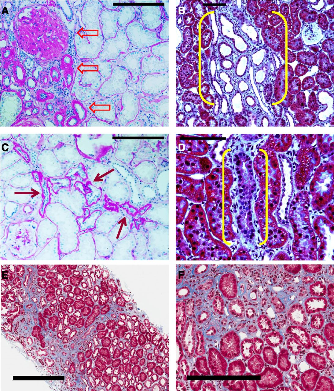 Kidney Tubular Injury And Chronic Fibrosis BONVENTRE LABORATORY